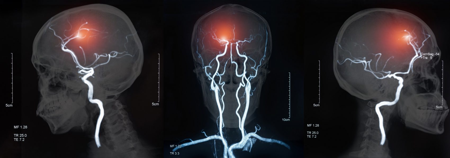 MRI blood vessels in brain cerebrovascular disease